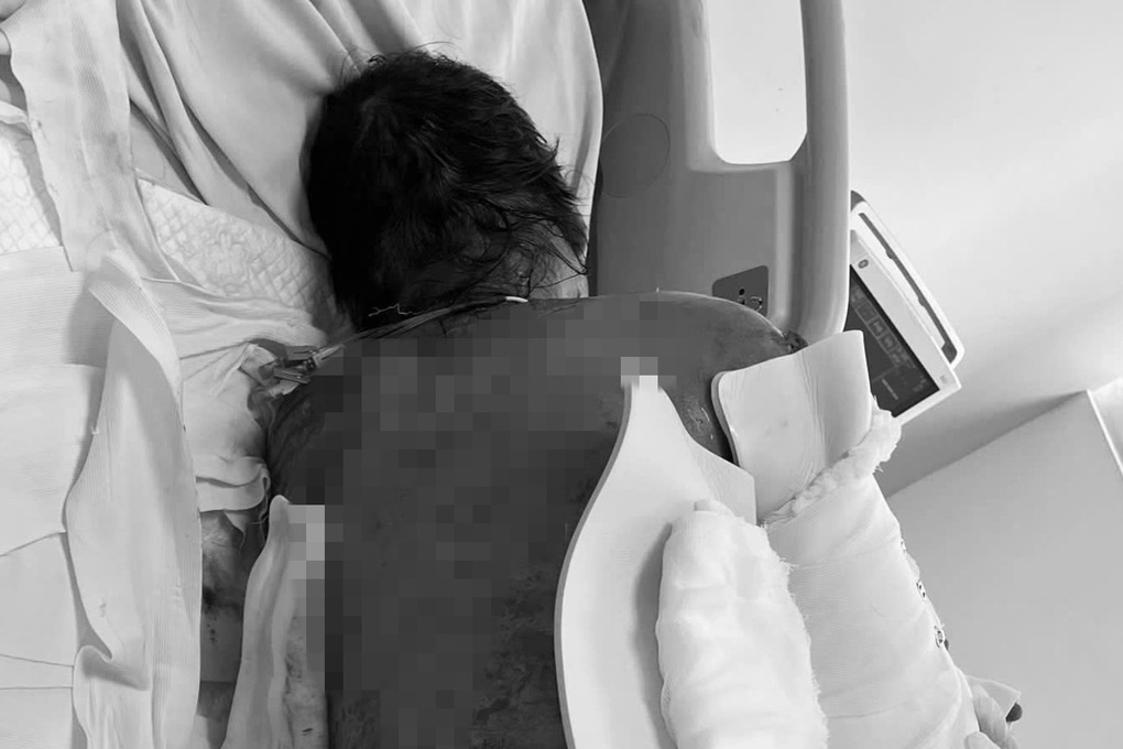 Hội chứng hiểm khiến người phụ nữ bong tróc da 92% sau khi dùng kháng sinh - 1 Hội chứng hiểm khiến người phụ nữ bong tróc da 92% sau khi dùng kháng sinh - 1